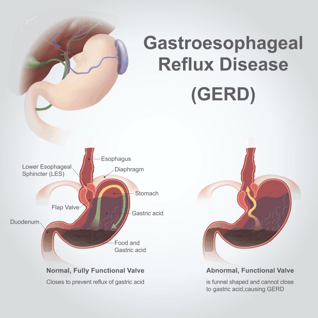 acid-reflux-putting-out-the-fire-dr-andrew-hubbard-nd